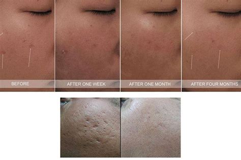 [misc] As promised, an update of 8 weeks post 2nd tca cross.